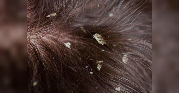 Не мийте голову холодною або гарячою водою: що потрібно знати, якщо у вас лупа - INFBusiness