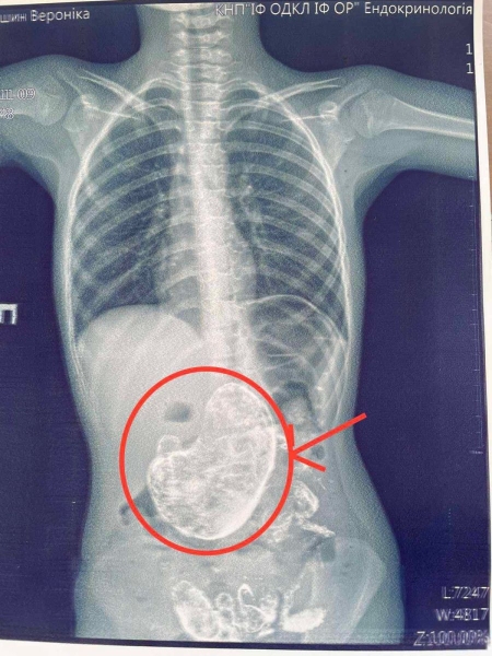 Після того, як у Києві лікарі врятували дитину, яка проковтнула 20 магнітів, у Івано-Франківську лікарі дістали зі шлунку дівчинки один кілограм волосся. Про це повідомив генеральний директор Івано-Франківської обласної дитячої клінічної лікарні. 1