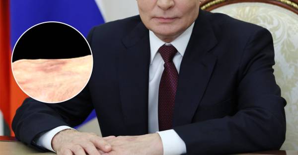Слід від ін'єкції на долоні Путіна: що це означає 6